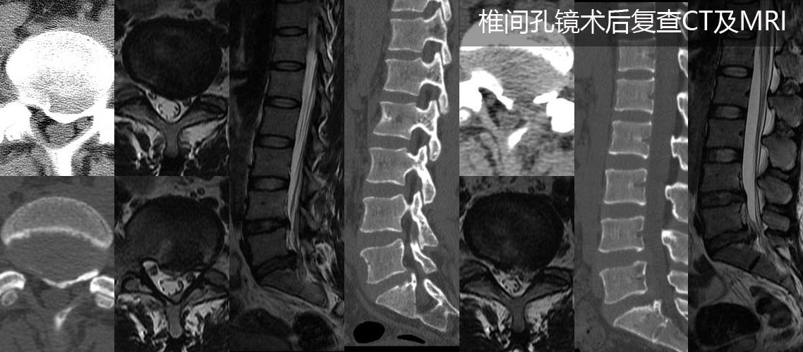 椎间孔镜下合并钙化髓核摘除术（男，30岁）.jpg