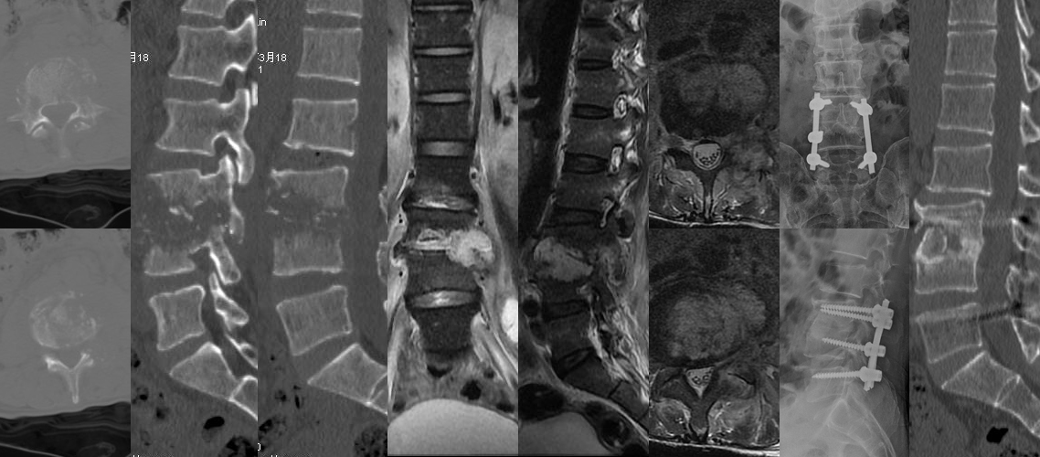 腰椎结核前后路病灶清除植骨固定术（男，55岁）.jpg